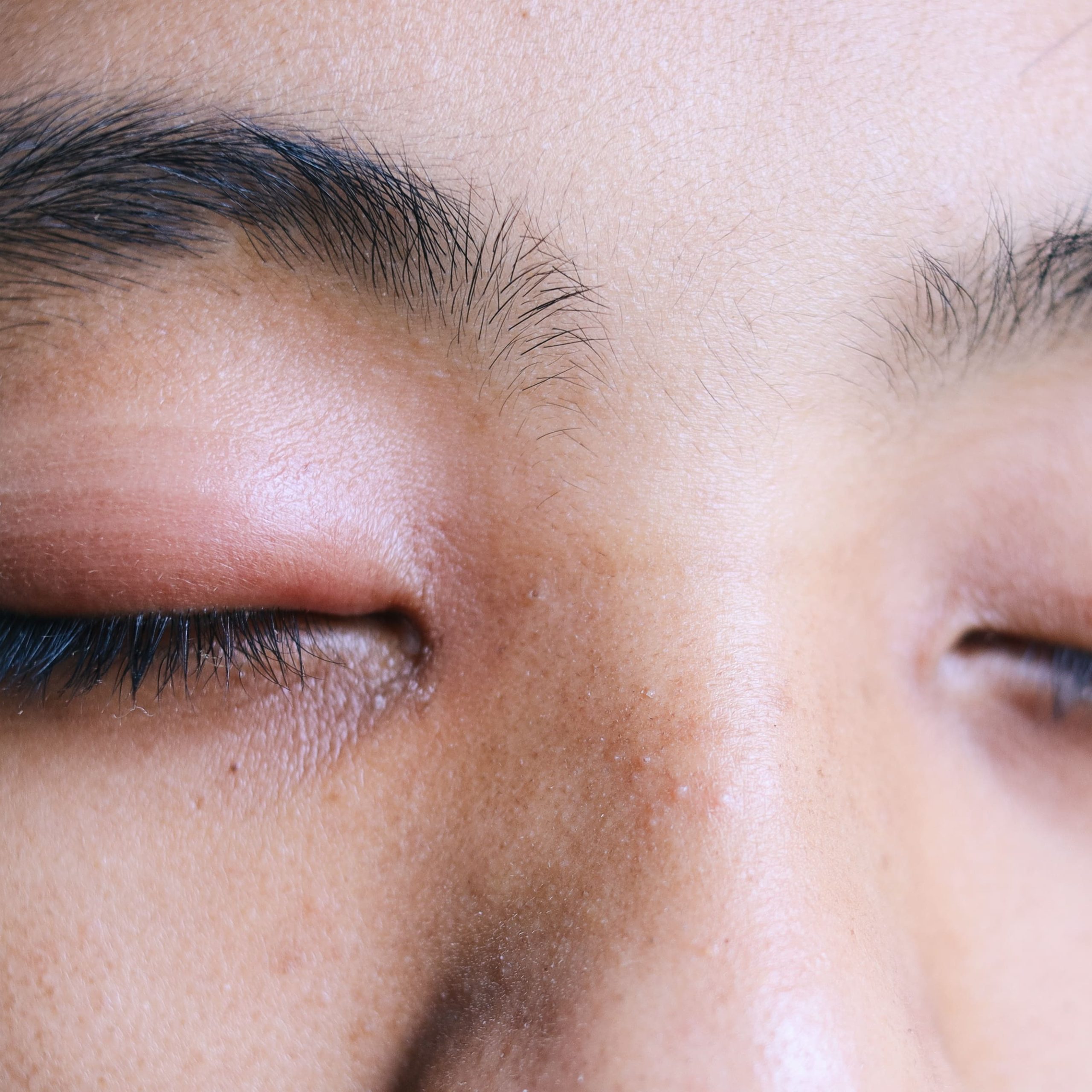 Що таке демодекоз повік та як його лікувати